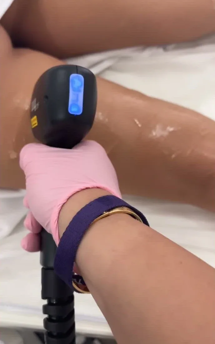 A gloved specialist applying the laser handpiece during a leg treatment