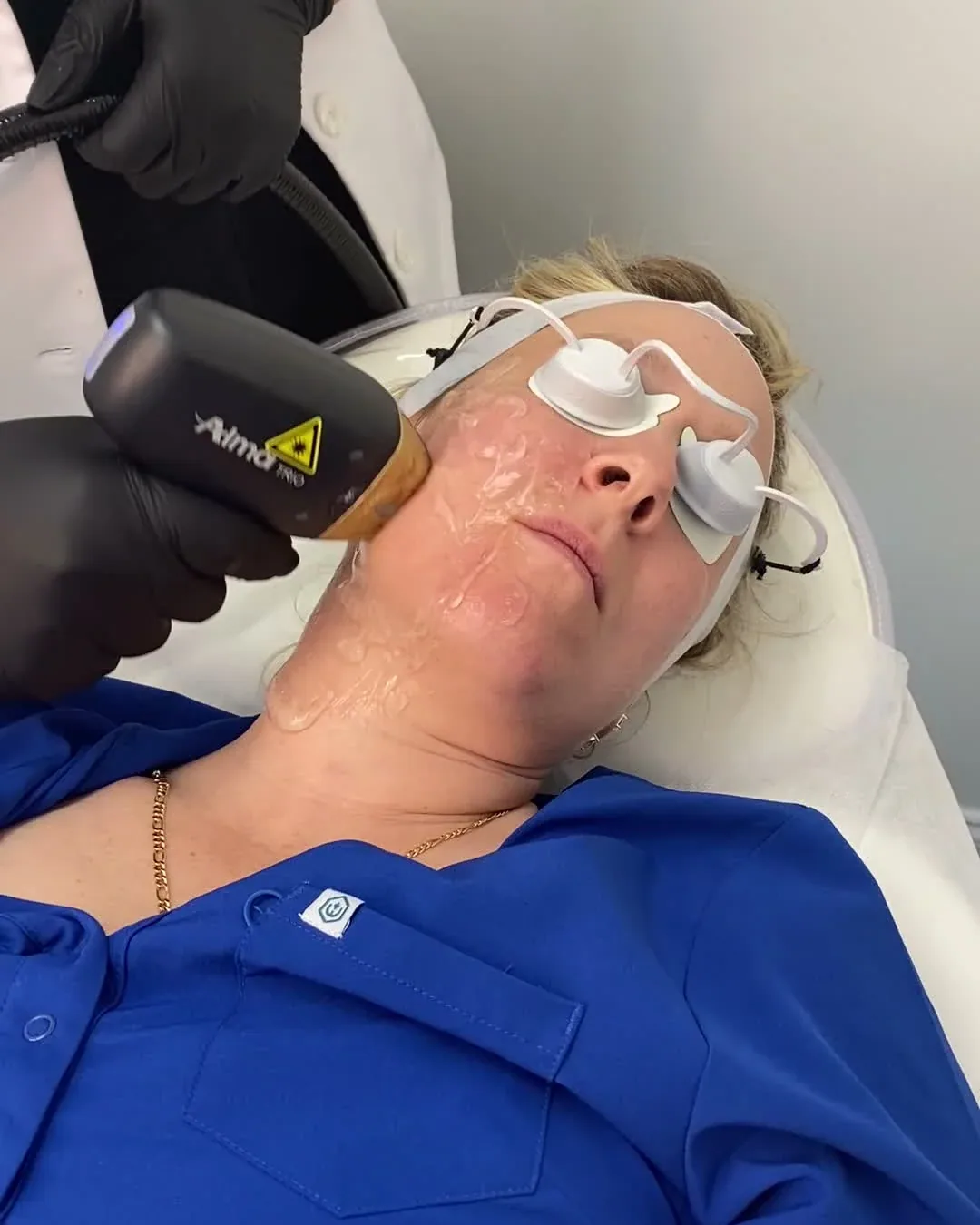 Protective eye shields and handpiece application during a Titanium facial treatment
